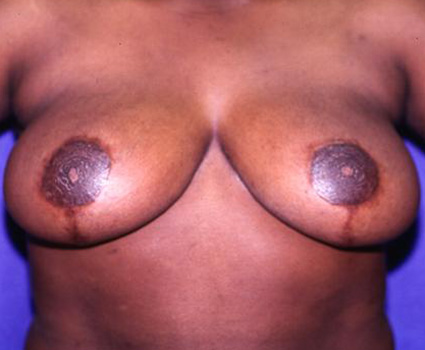BREAST REDUCTION 55