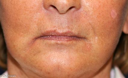 lip-procedure