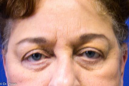 brow-lift-before