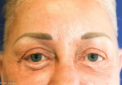 UPPER AND LOWER BLEPHAROPLASTY FORT LAUDERDALE 11