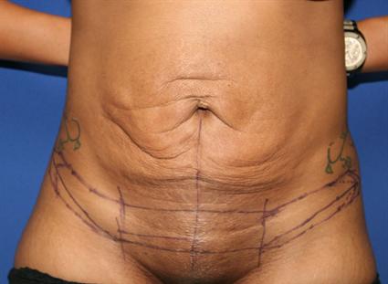 tummy tuck frontal before