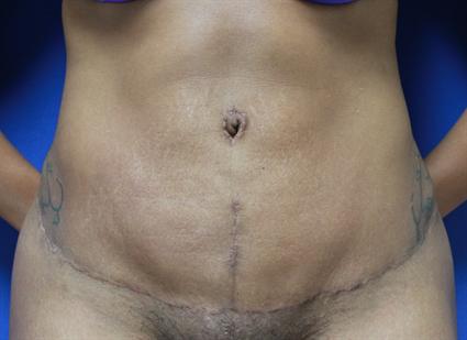 TUMMY TUCK - ABDOMINOPLASTY CASE 117