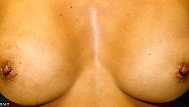 NIPPLE REDUCTION 119
