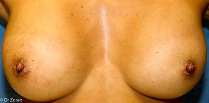 NIPPLE REDUCTION 119