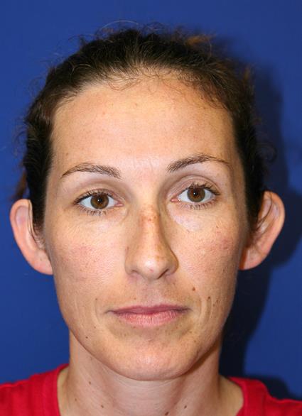 before-otoplasty-ear-shaping