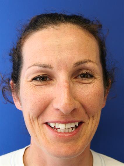 MIAMI OTOPLASTY PATIENT 12