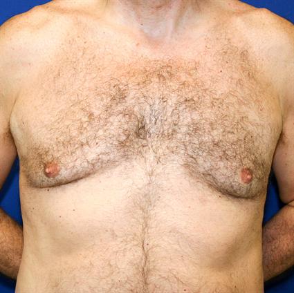 MALE BREAST SURGERY - GYNECOMASTIA CASE 144