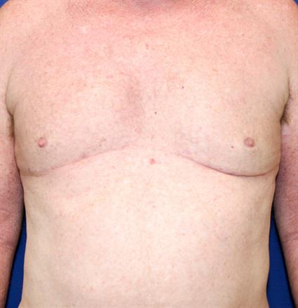 MALE BREAST SURGERY - GYNECOMASTIA 145