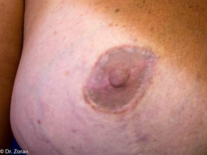 NIPPLE/AREOLA SURGERY 148