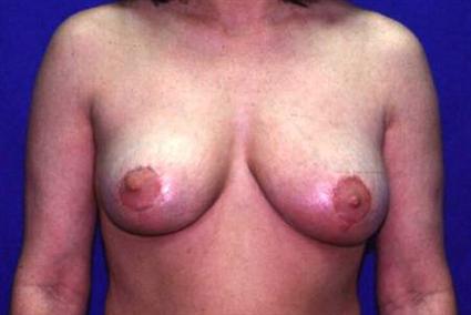 BREAST ASYMMETRY CASE 151