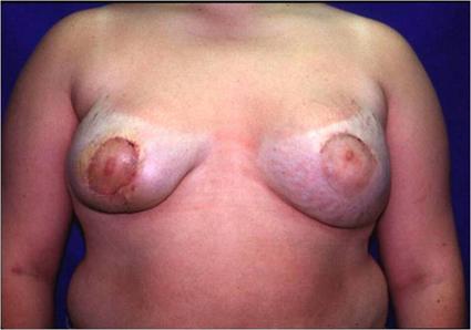 BREAST RECONSTRUCTION 153