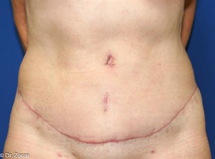 TUMMY TUCK - ABDOMINOPLASTY 156