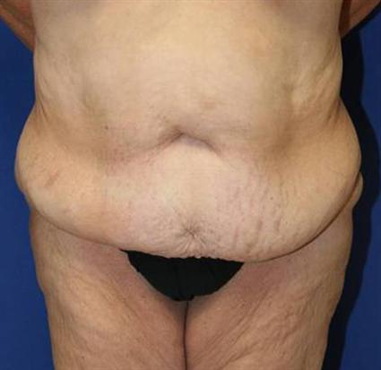 tummy tuck with liposuction before