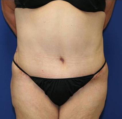 TUMMY TUCK WITH LIPOSUCTION- ABDOMINOPLASTY 157
