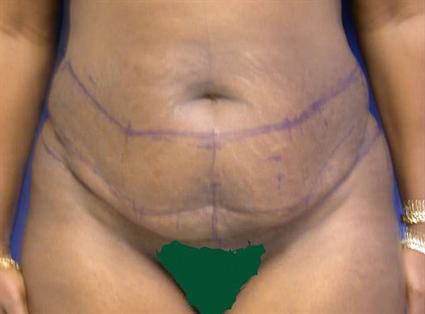 before tummy tuck