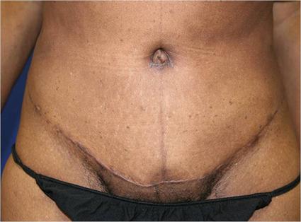 TUMMY TUCK WITH LIPOSUCTION - ABDOMINOPLASTY 158