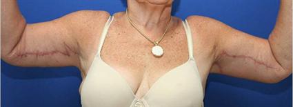 ARM LIFT WITH LIPOSUCTION 161