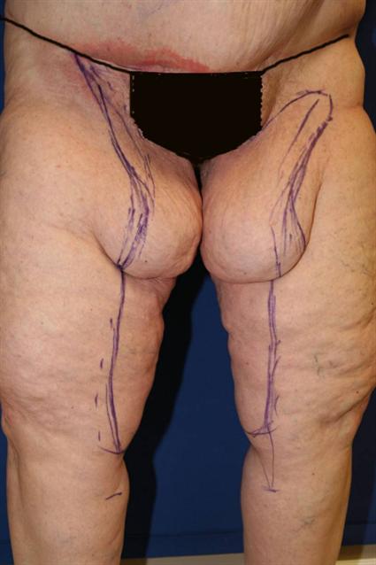 before female thigh lift