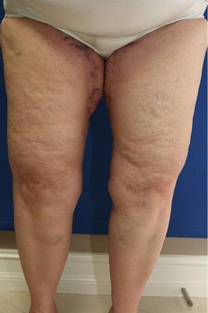 THIGH LIFT 163