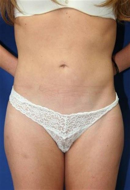 LIPOSUCTION 164