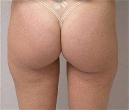 LIPOSUCTION 166
