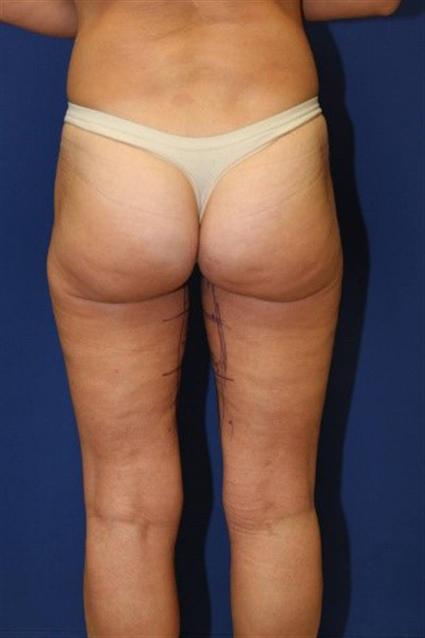 back view female thigh lift before