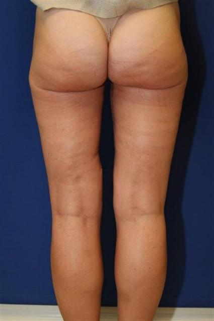 THIGH LIFT 168