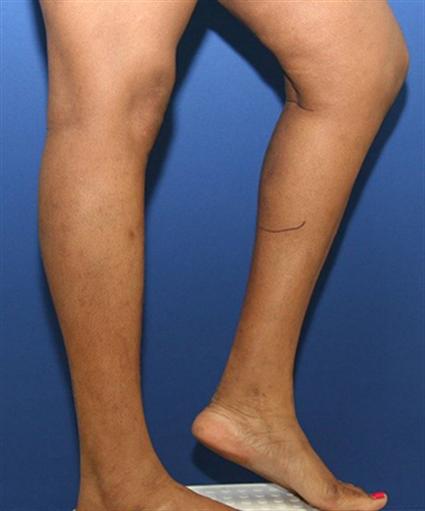 before female calf implants