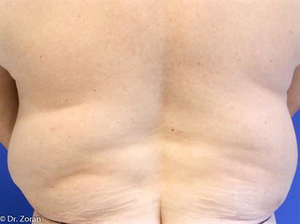 body contouring