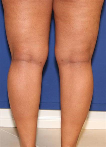 before female calf reshaping and silicone implants
