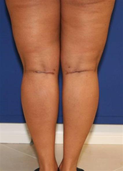 CALF IMPLANTS CASE 170