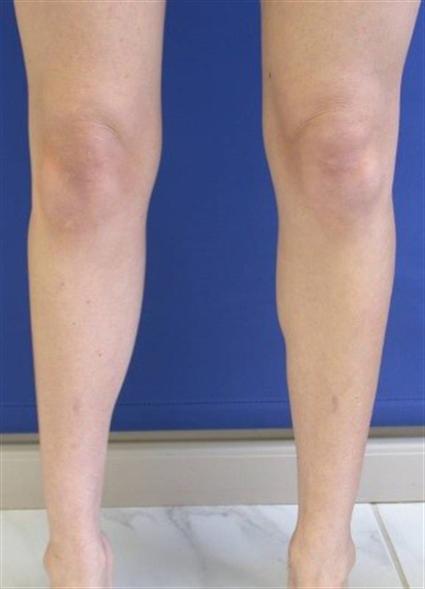 CALF IMPLANTS CASE 171