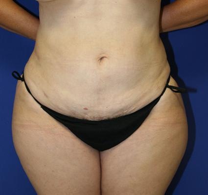 LIPOSUCTION 176