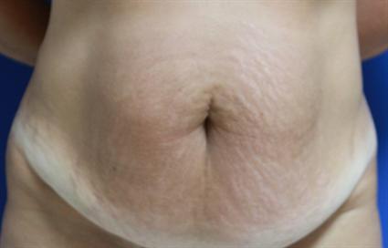 before female tummy tuck