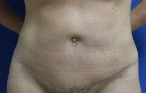 after female tummy tuck