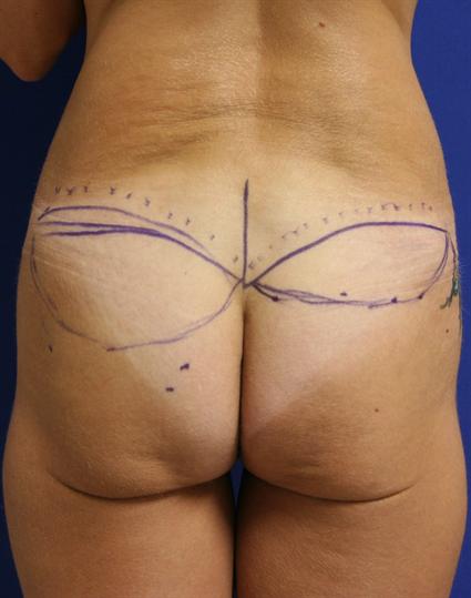 before buttock lift