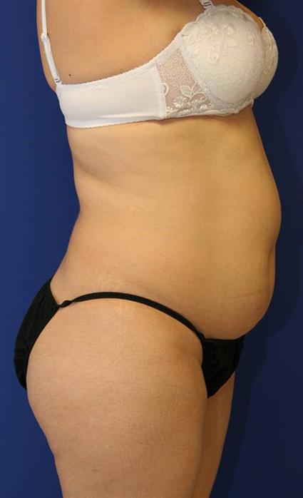 body contouring