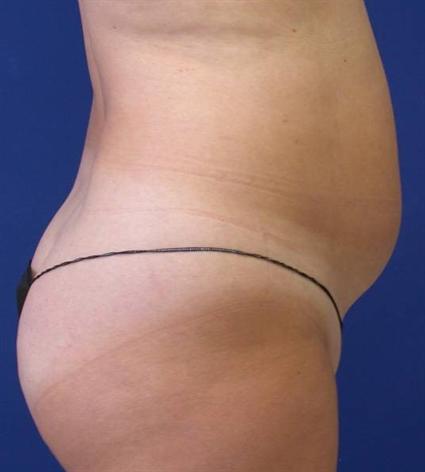 body contouring