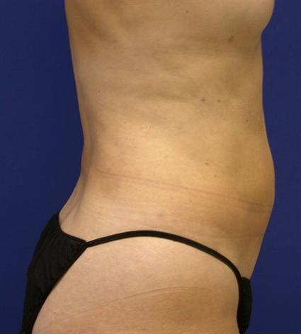 BODY CONTOURING WITH TUMESCENT TECHNIQUE 185