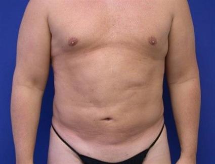 BODY CONTOURING 186