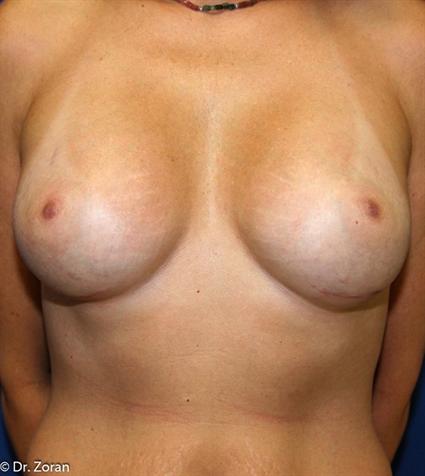 BREAST AUGMENTATION 187