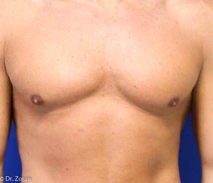 GYNECOMASTIA 19