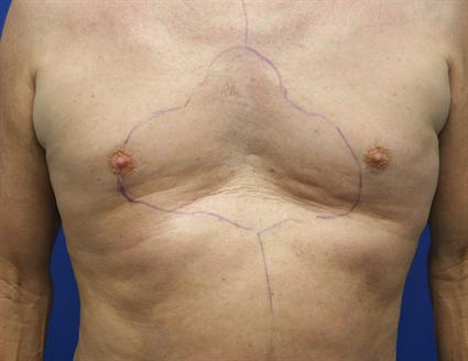 before male body fat graft