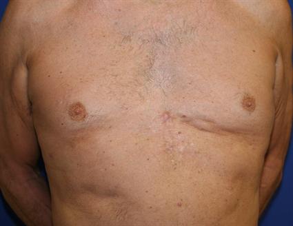 Breast fat grafting-chest and breast deformity correction with fat grafts