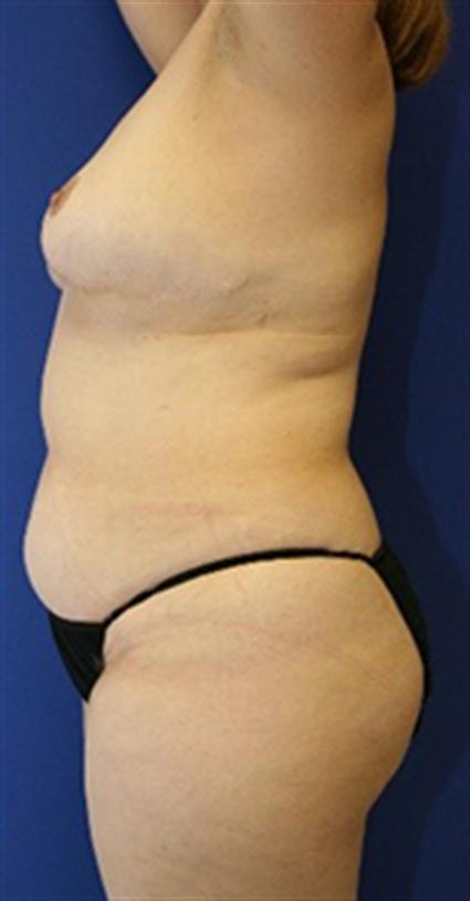 REVERSE OR UPPER ABDOMINOPLASTY