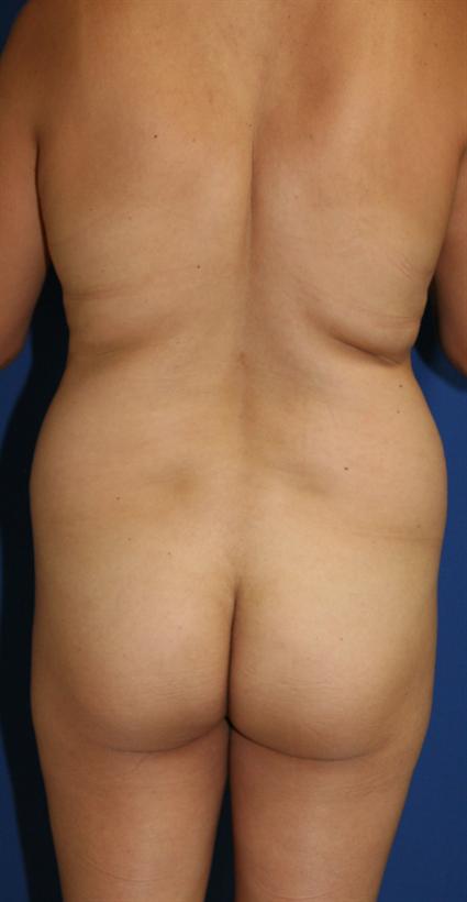 before female buttock lift