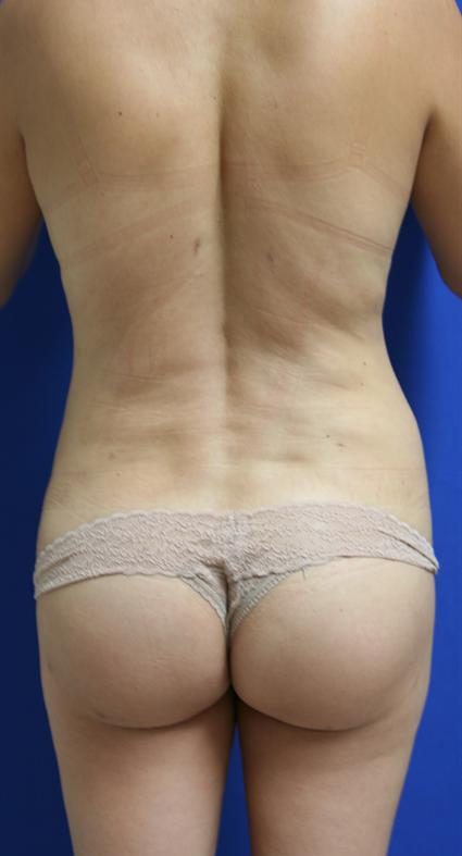 BUTTOCK LIFT 200