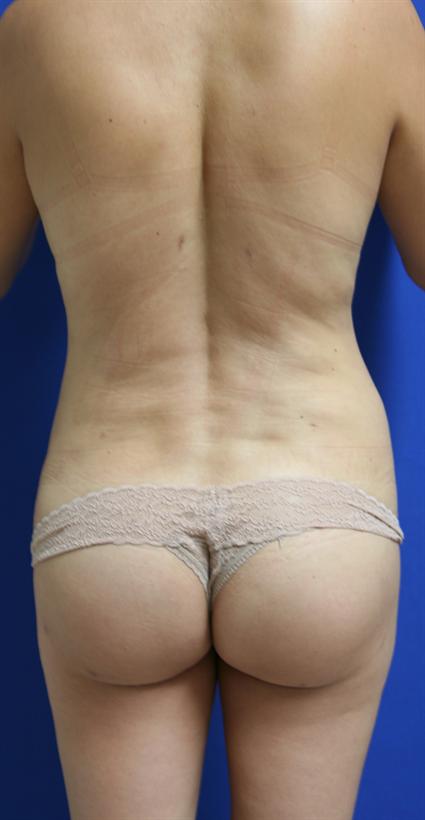 BUTTOCK LIFT 200