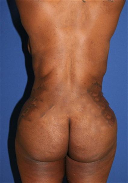 BUTTOCK AUGMENTATION 203