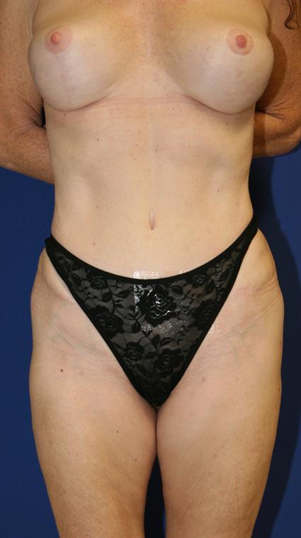 LIPOSUCTION 207